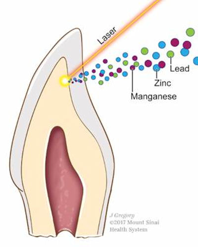 Tooth Laser Manganese Lead Zinc