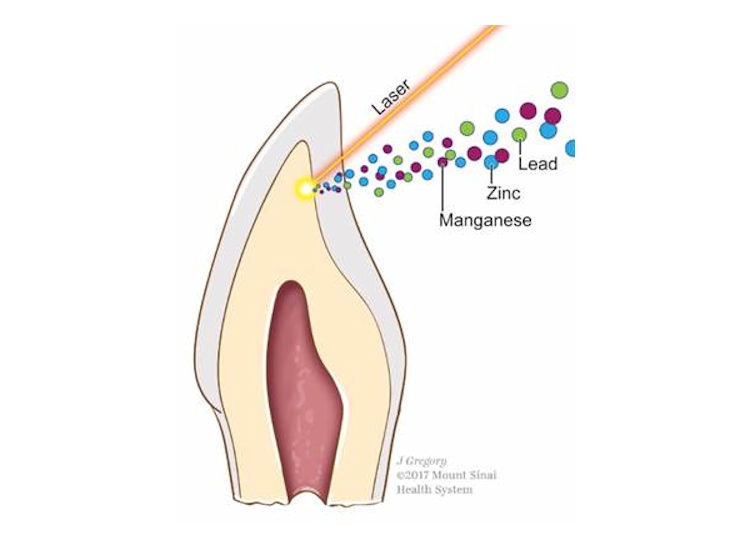Tooth Laser Manganese Lead Zinc